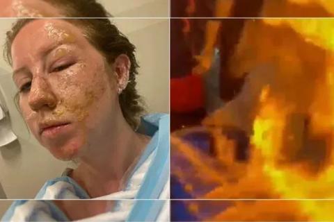 Mesero quema el rostro de una mujer al flamear su bebida en Cancún