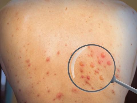 Llegó la viruela del mono a Tlaxcala, confirma la Secretaria de Salud