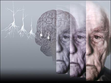 Afecta Alzheimer al 10 por ciento de mayores de 70 años