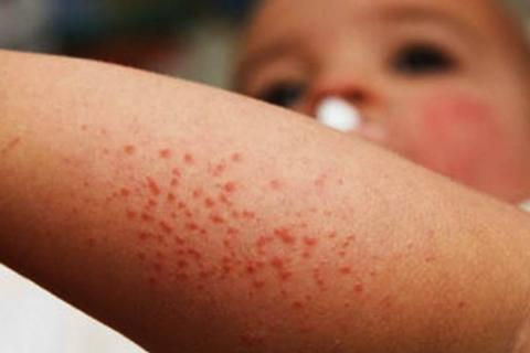 Epidemia de Coxsackie en Tlaxcala; hay más de 100 casos