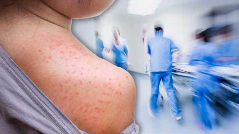 Tlaxcala registra diez contagios de sarampión al último reporte sanitario