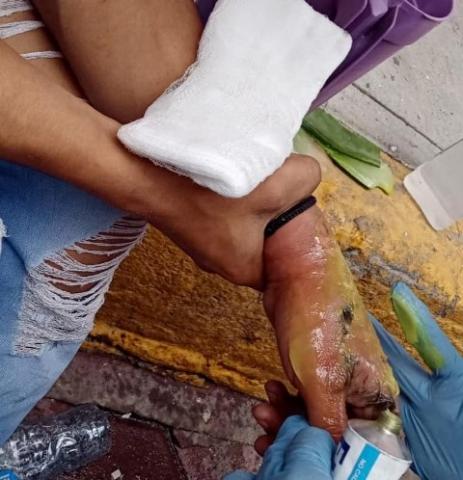 Le explota un cohetón en la mano a mayordomo San Pablo del Monte